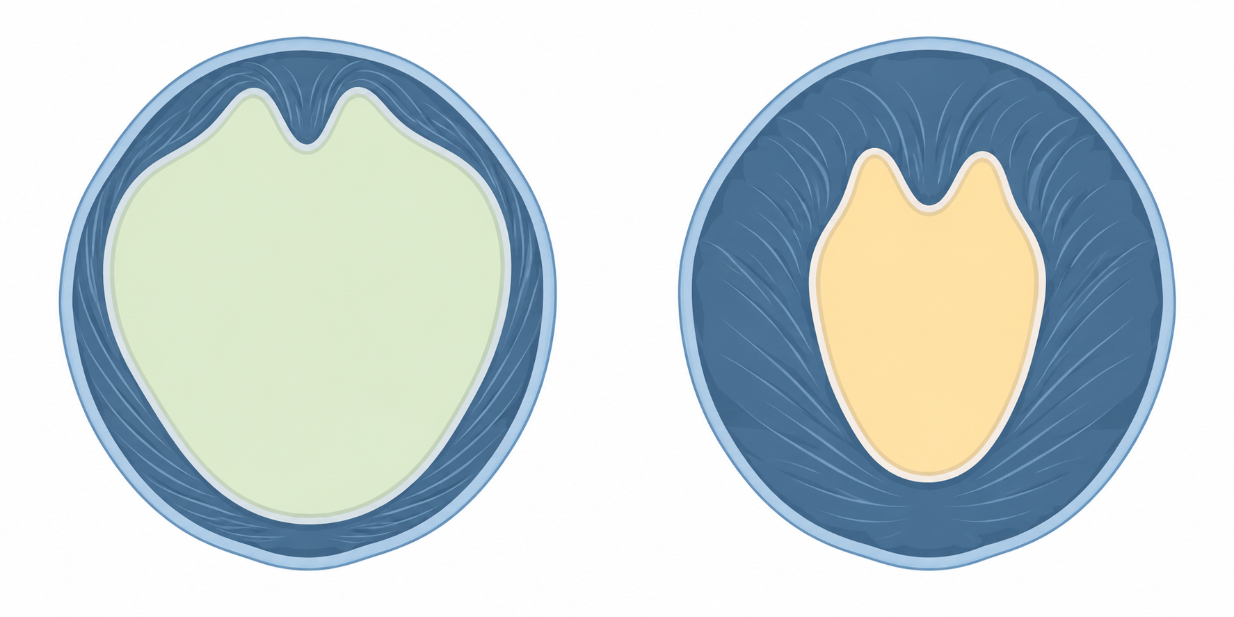 Side-by-side schematic left-ventricle sections at equal scale: a wide cavity with a thin wall versus a narrow cavity with a thick wall.